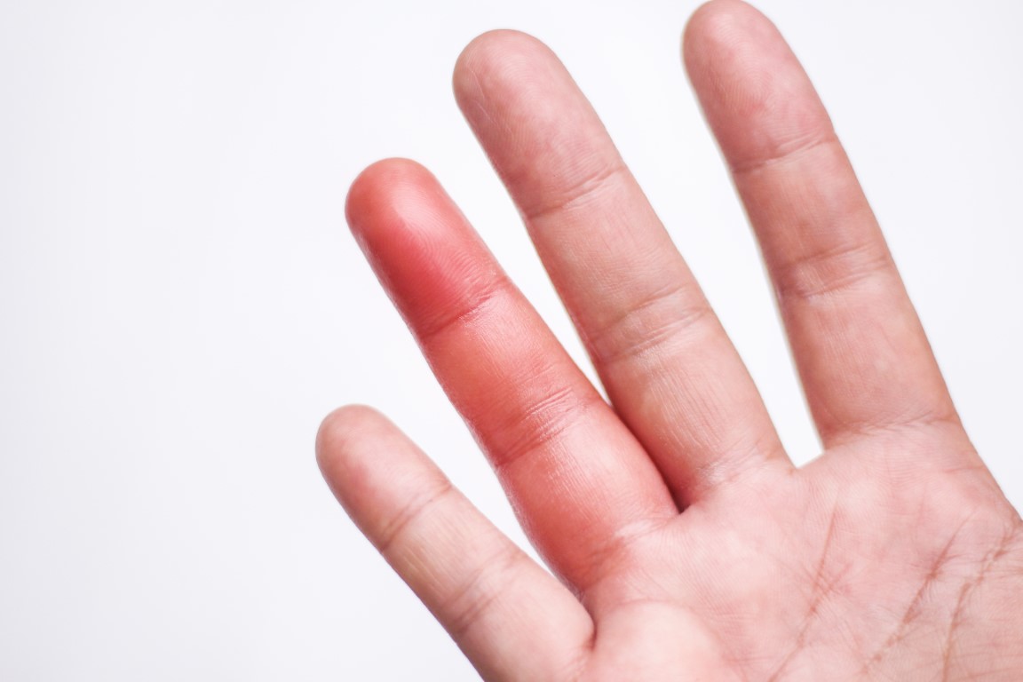 Swollen finger and difficulty bending it: causes and how to react ...