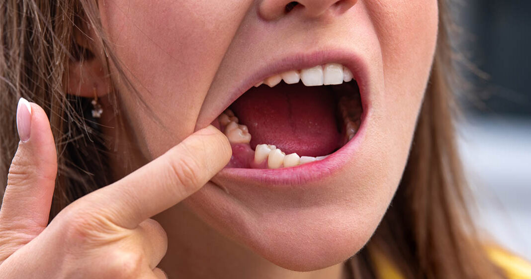 Dans l'avenir, un médicament pourrait faire repousser naturellement les dents